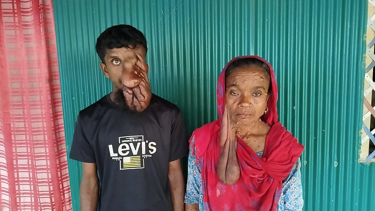 বিরল রোগে আক্রান্ত মা ও ছেলে