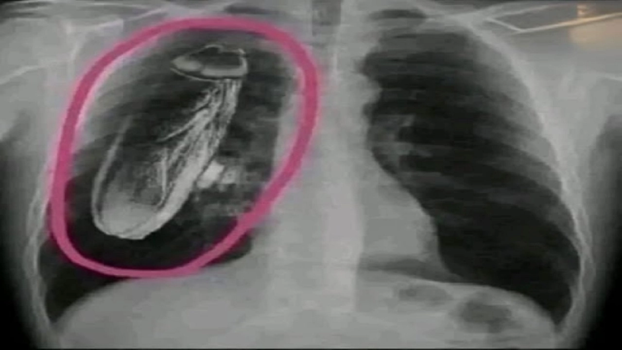 বুকের ভেতর তেলাপোকা শনাক্ত