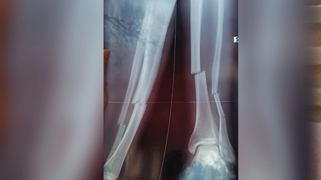 এক্স রে রিপোর্ট