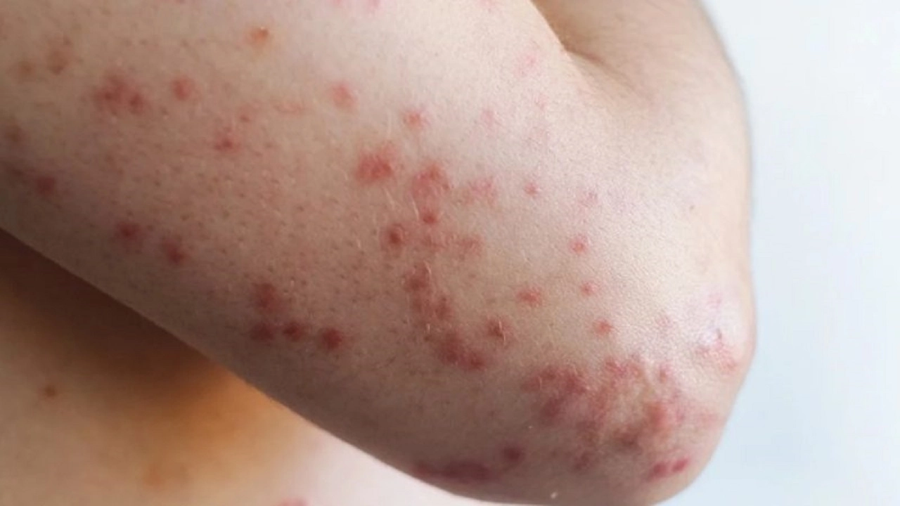 গোপালগঞ্জে হামের উপসর্গ নিয়ে ৪২ শিশু হাসপাতালে