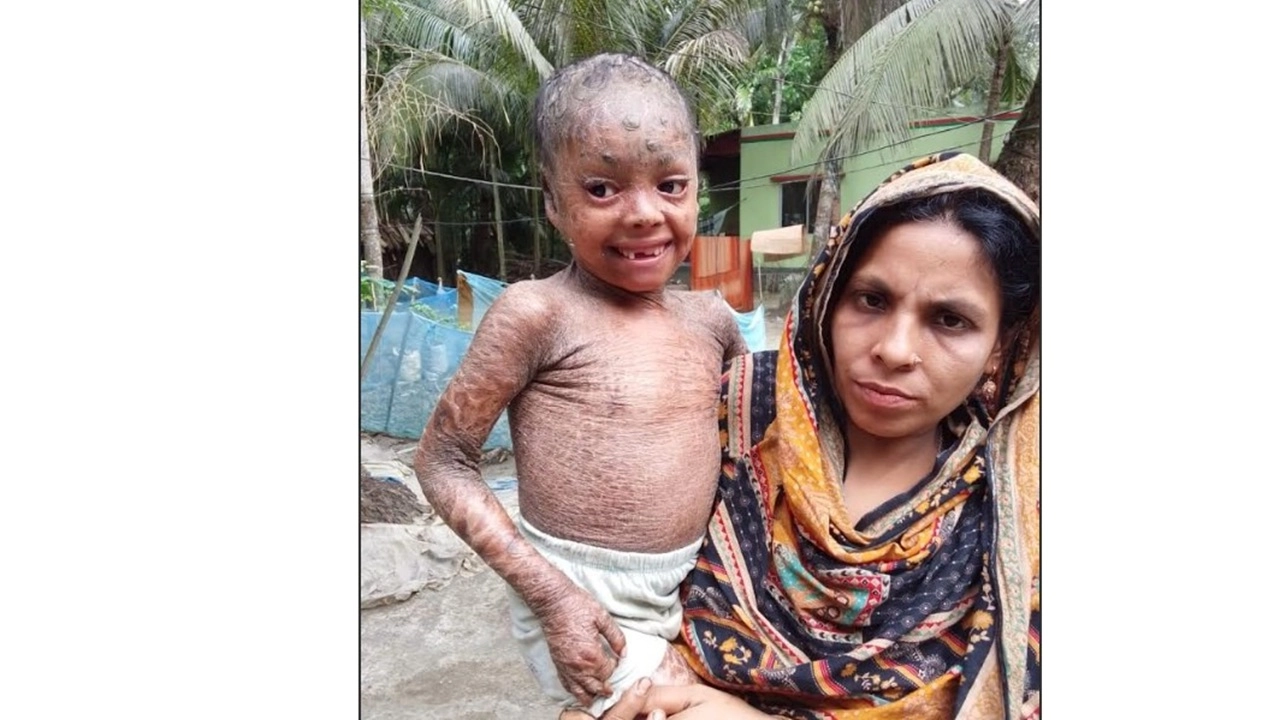 পিরোজপুরে বিরল চর্মরোগে আক্রান্ত ছোট্ট তানিয়া, বাঁচাতে দরকার মানবিক সহায়তা