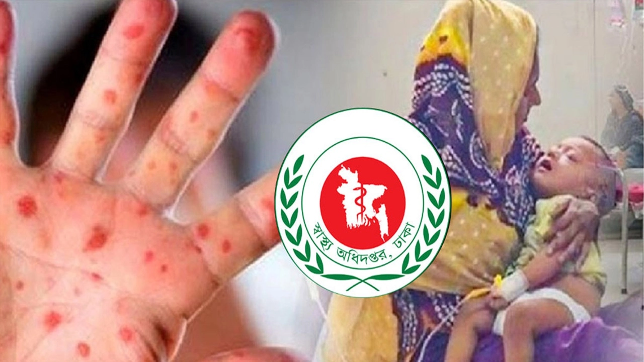 হামের উপসর্গে ২৪ ঘন্টায় আরও ৩ শিশুর মৃত্যু