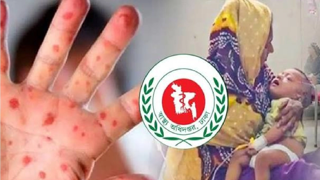 হাম ও উপসর্গে মৃত্যু বেড়ে ৭৮০